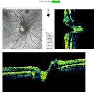 OCT-NERVIO-OPTICO-2-PRUEBA-MEDICA-OFTALNOVA-BARCELONA-200x200