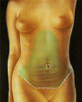 Separación de la piel de la pared abdominal hasta las costillas