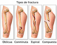 Traumatismos del muslo