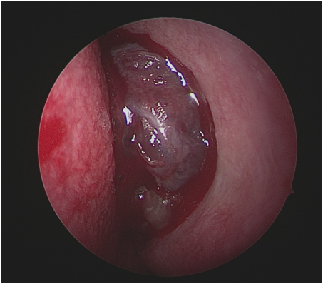cirugía de base de cráneo