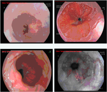 Diagnóstico esógafo de Barrett