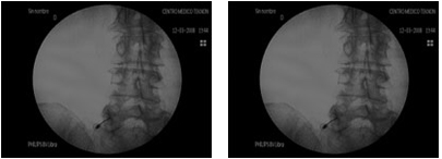 Infiltraciones articulares