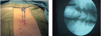 sistemas de estimulacion medular y de nervios perifericos