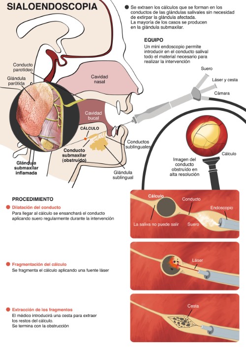 sialoendoscopia_nuevo
