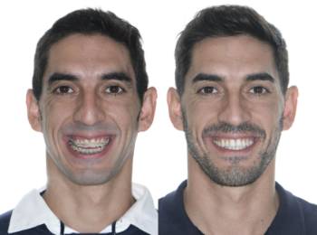 sonrisa estética Teknon