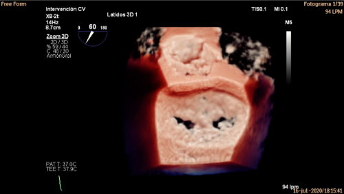 intervenciones mínimamente invasivas para la válvula mitral teknon