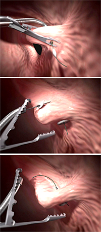 Teknon realiza las primeras reducciones de estómago por vía oral
