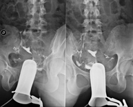 Hipsterosalpingografía (HSG)