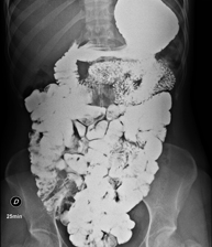 Tránsito intestinal