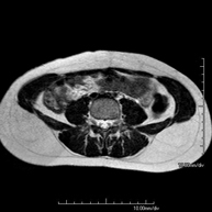 RM de Paret abdominal