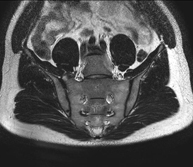 RM de sacroilíaques