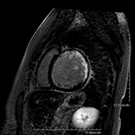 RM cardíaca amb estrès miocardi