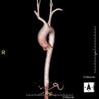 Angio-RM Aorta Torácica