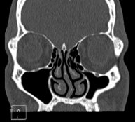 TC Senos paranasales
