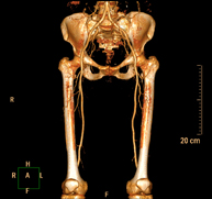 Angio-TC arterial extremidades inferiores