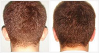 otoplastia