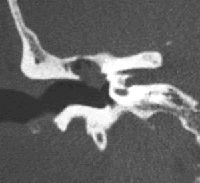 colesteatoma