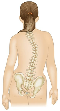 escoliosis