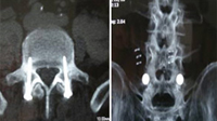 implantes6