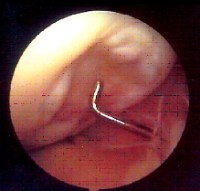 Osteocondritis disecante