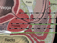 Crioterapia