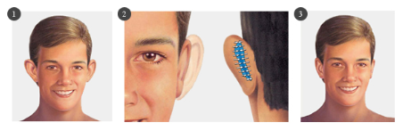 Otoplastia