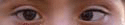 estrabismo_1