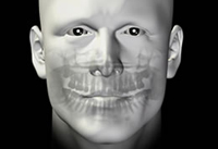 Tumor nasal