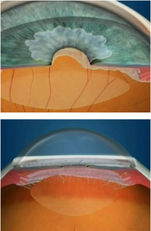 Glaucoma