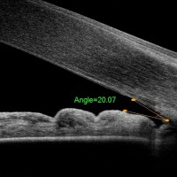 GONIOSCOPIA-Pruebas-oftalmologia-Oftalnova-Teknon-Barcelona-2-200x200