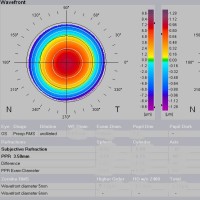 ABERROMETRIA-PRUEBA-OFTALMOLOGIA-OFTALNOVA-BARCELONA-1-200x200