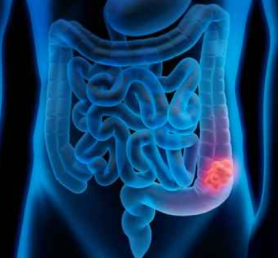 Unidad Cáncer de Colon | Centro Médico Teknon