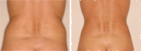 Liposucción_02