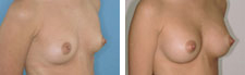 Mamoplastia_01