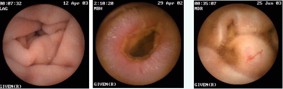 imágenes obtenidas con la cápsula endoscópica