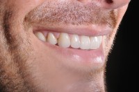 despues1