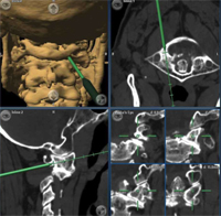 Columna cervical inflamatoria