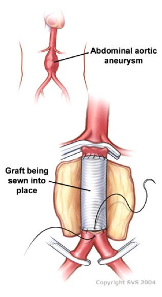 cirugia convencional aorta