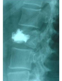 pre- y post-operatoria de una cifopastia cementada