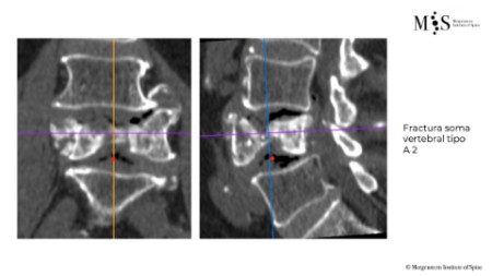 Caso clínico con estabilización percutánea de fractura vertebral inestable
