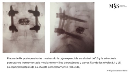 fusión endoscópica 2