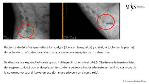 fusion endoscópica-update