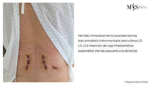 fusión endoscópica caso clínico