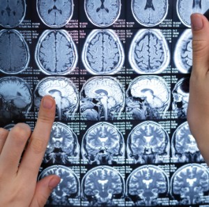 cirugia-malformaciones-cerebrales