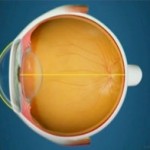 Miopia_Ojo_emetrope_Oftalnova_Clinica_Oftalmologia_Barcelona_-150x150