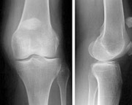 Fracturas de rótula_02