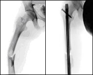Fracturas de fémur