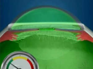 Oftalnova_oftalmologos_Barcelona_Soluciones_para_el_glaucoma-300x224