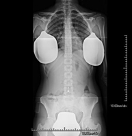 Telerradiología columna