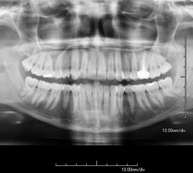 RX Mandibular